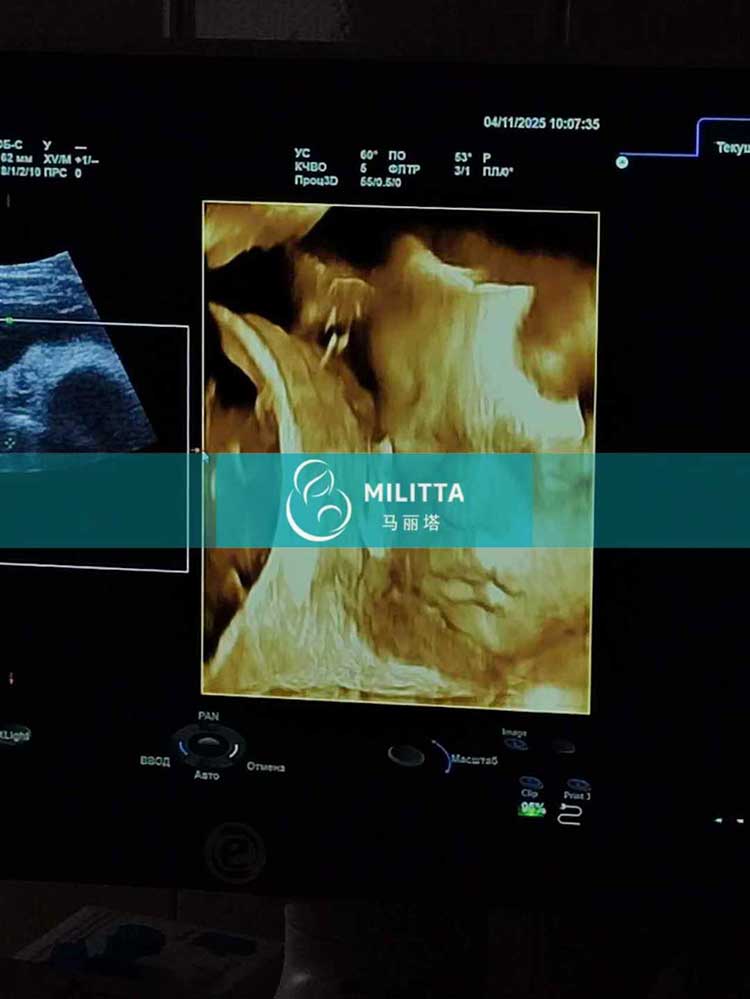 试管妈妈做四维彩超