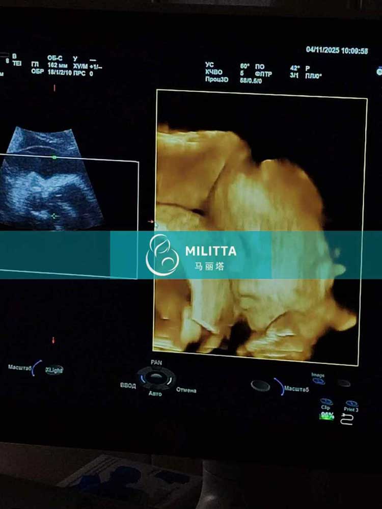 试管妈妈做四维彩超