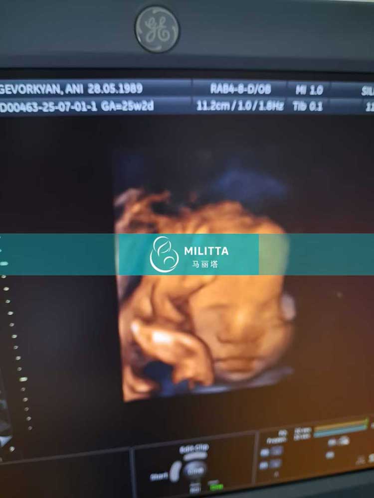 试管妈妈做孕检