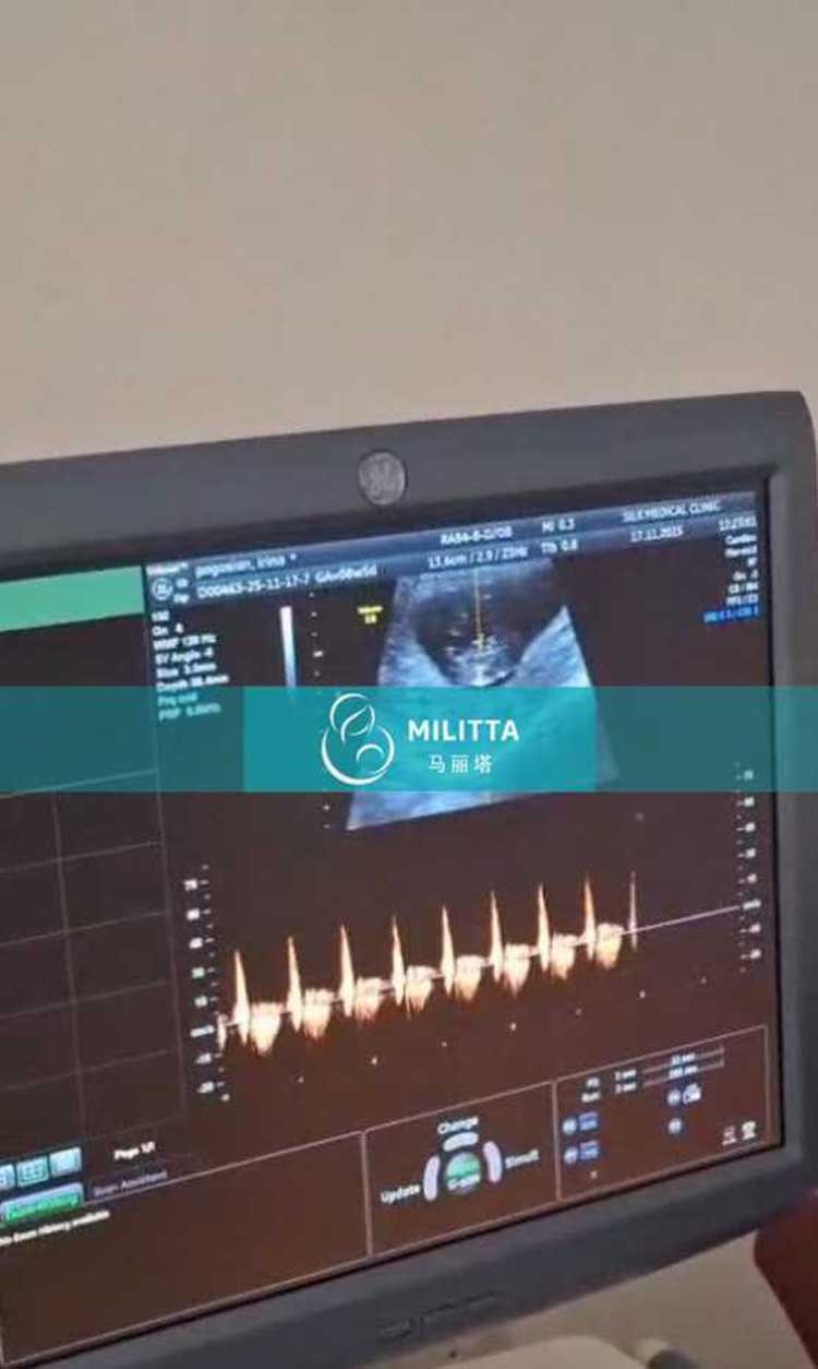 试管妈妈做B超