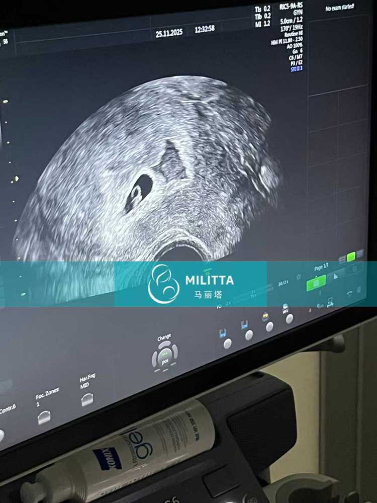 试管妈妈做首次B超