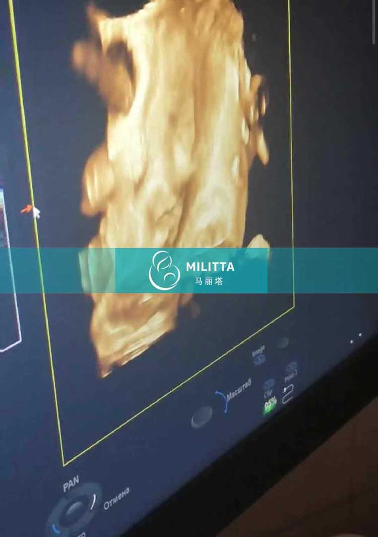 乌克兰试管妈妈做B超