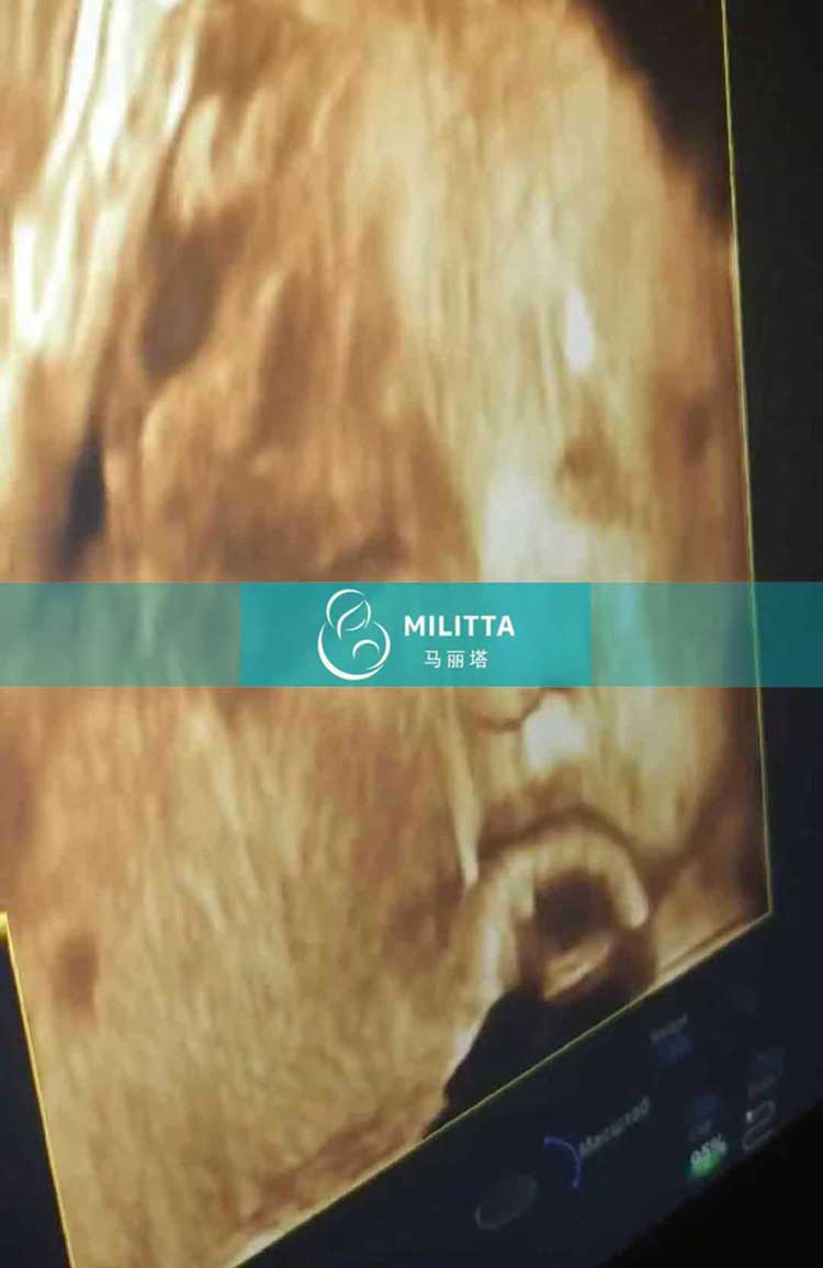 乌克兰试管妈妈做B超