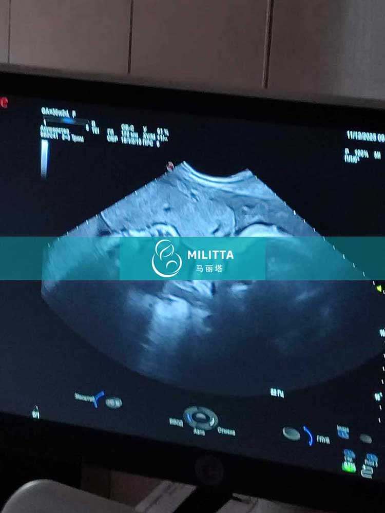 试管妈妈做产检