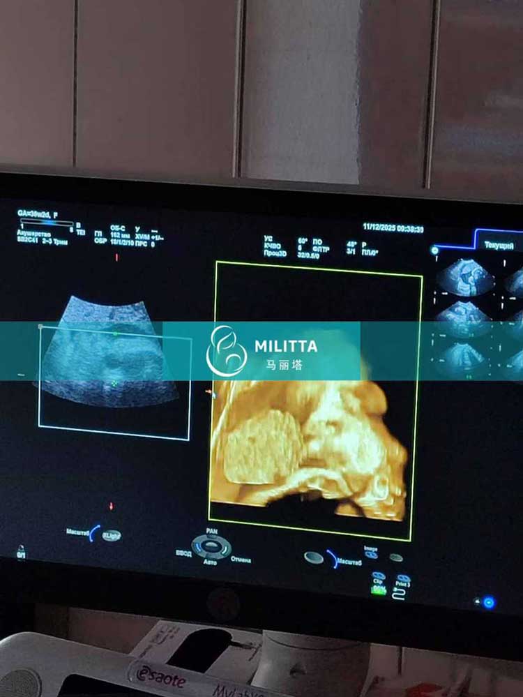 试管妈妈做产检