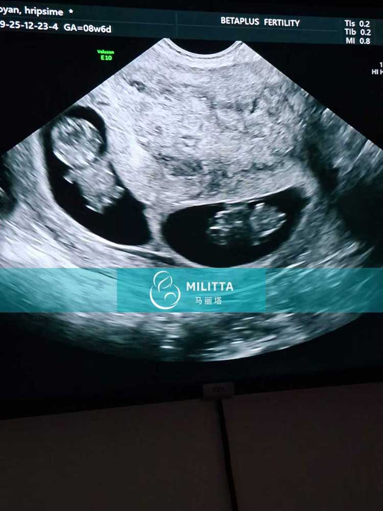 试管妈妈做B超