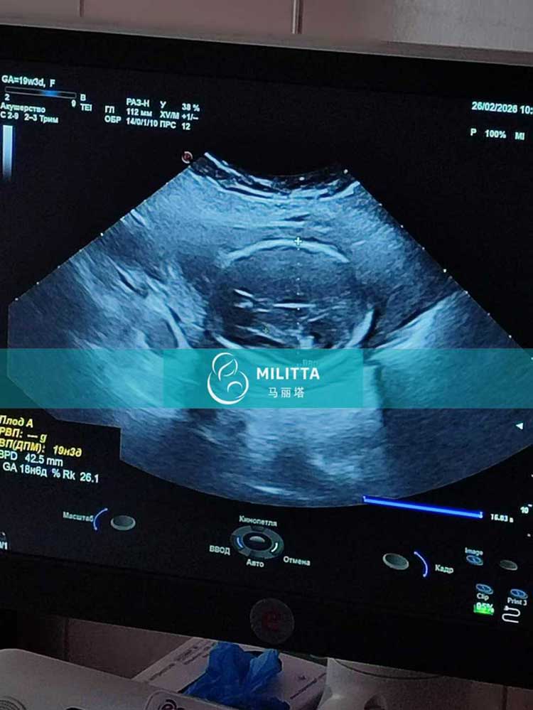 试管妈妈做B超