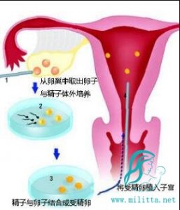 在乌克兰做自卵试管助孕取卵注意事项